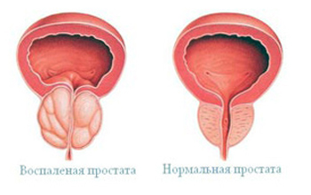 Простатит - довольно неприятный диагноз для любого мужчины